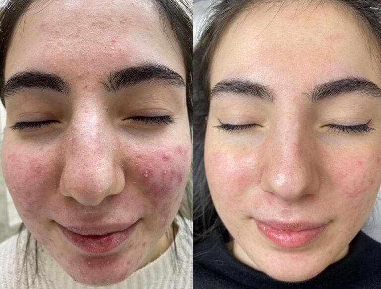 Before and after enzyme therapy skin progress result 01