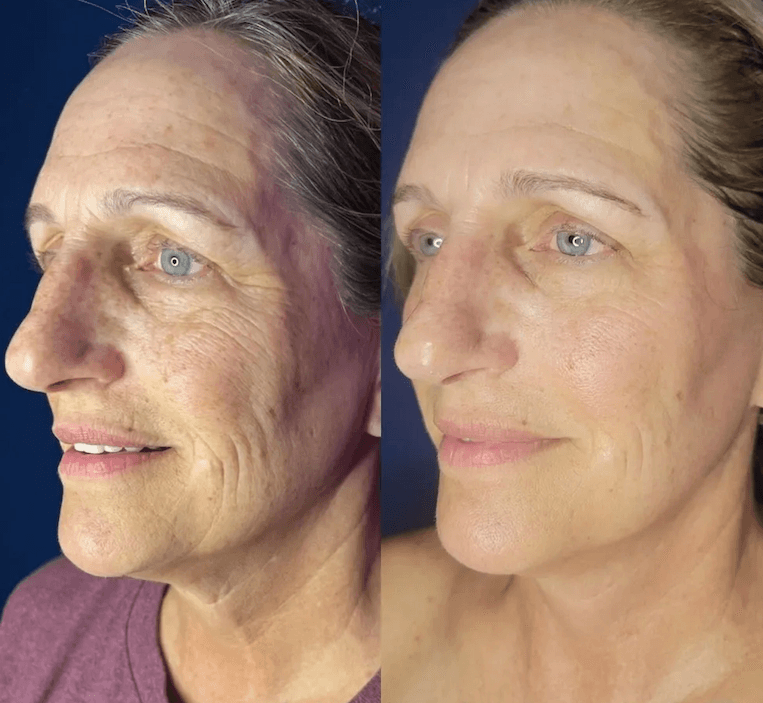 Before and after enzyme therapy skin progress result 02