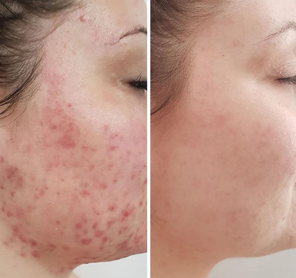 Before and after enzyme therapy skin progress result 03