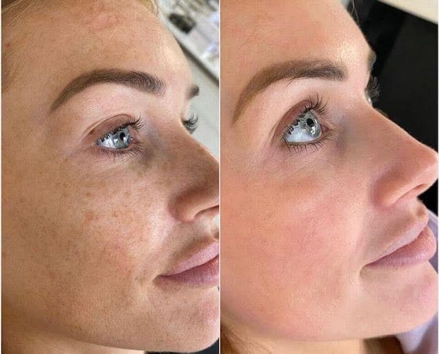 Before and after enzyme therapy skin progress result 04