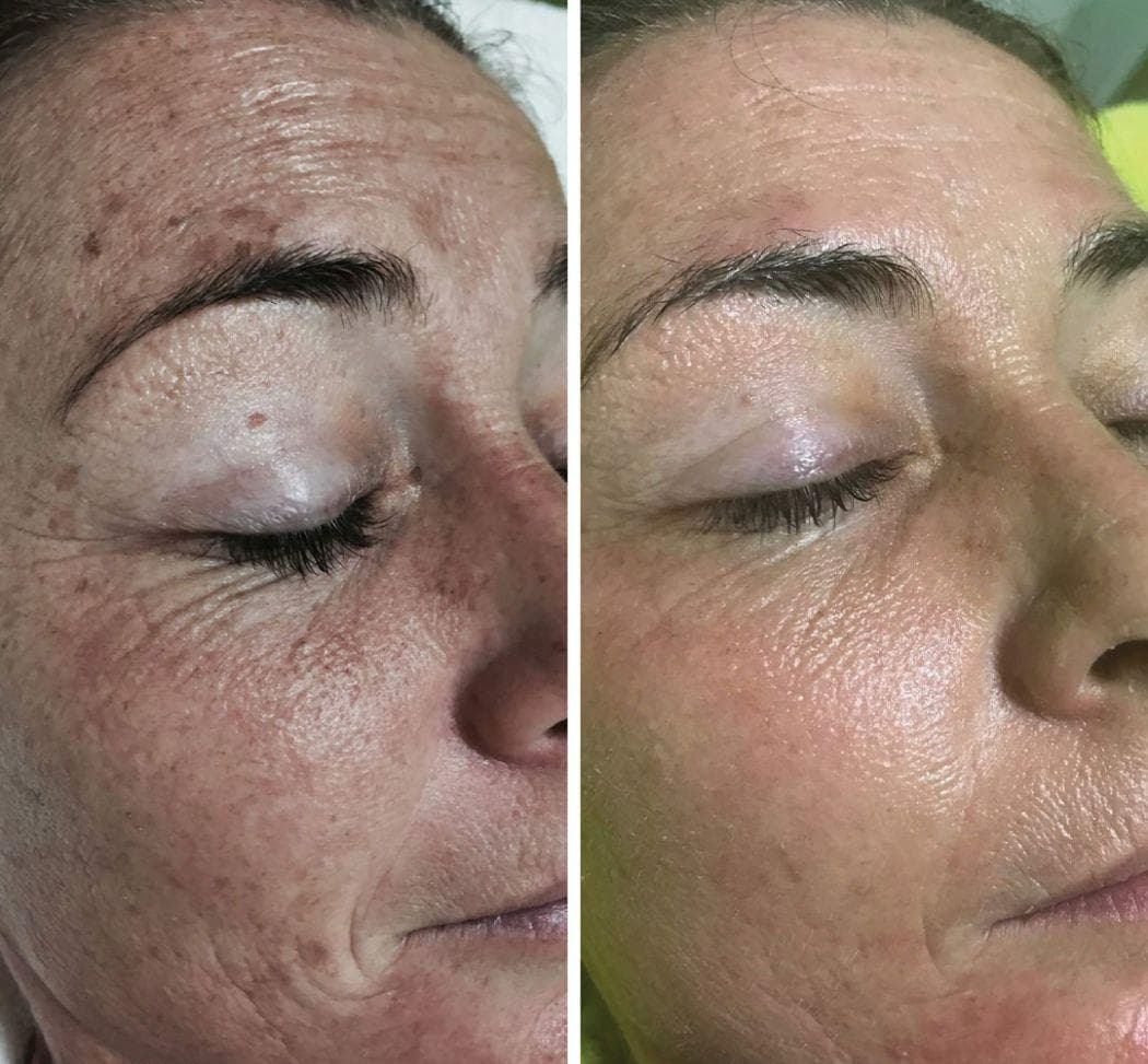 Before and after enzyme therapy skin progress result 05