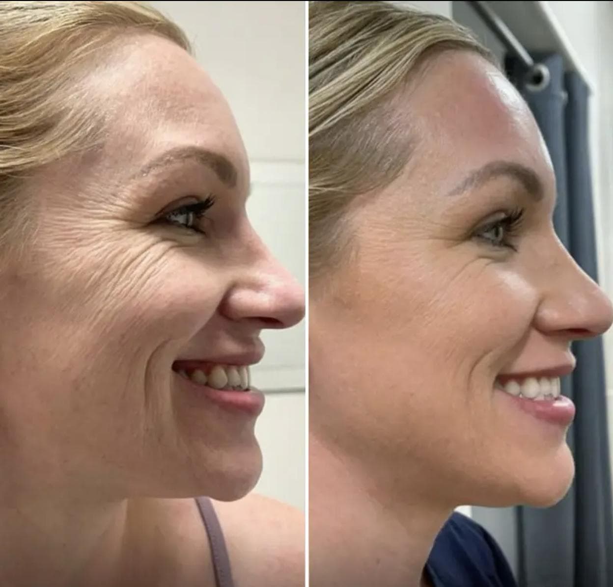 Before and after enzyme therapy skin progress result 06