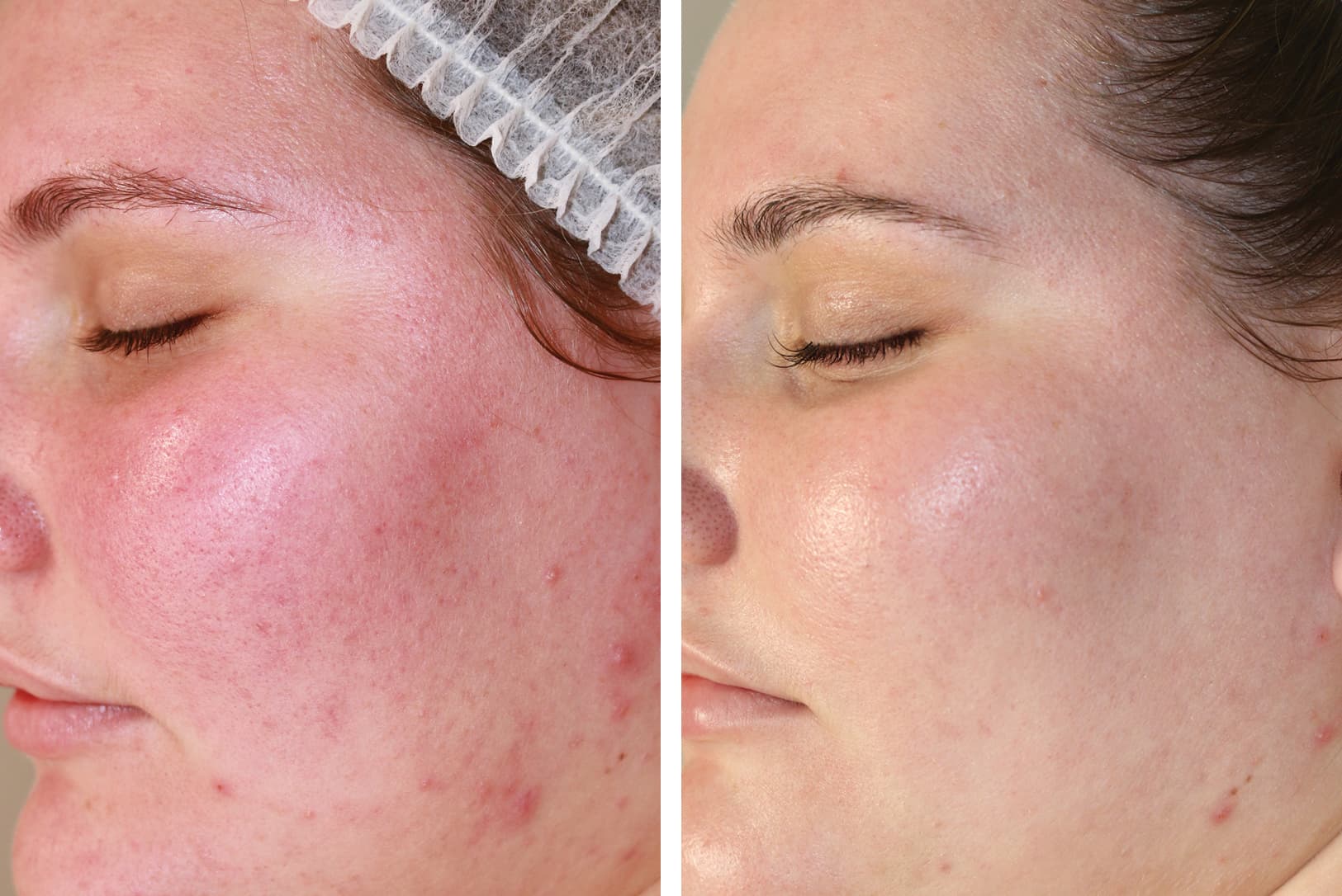 Before and after enzyme therapy skin progress result 07