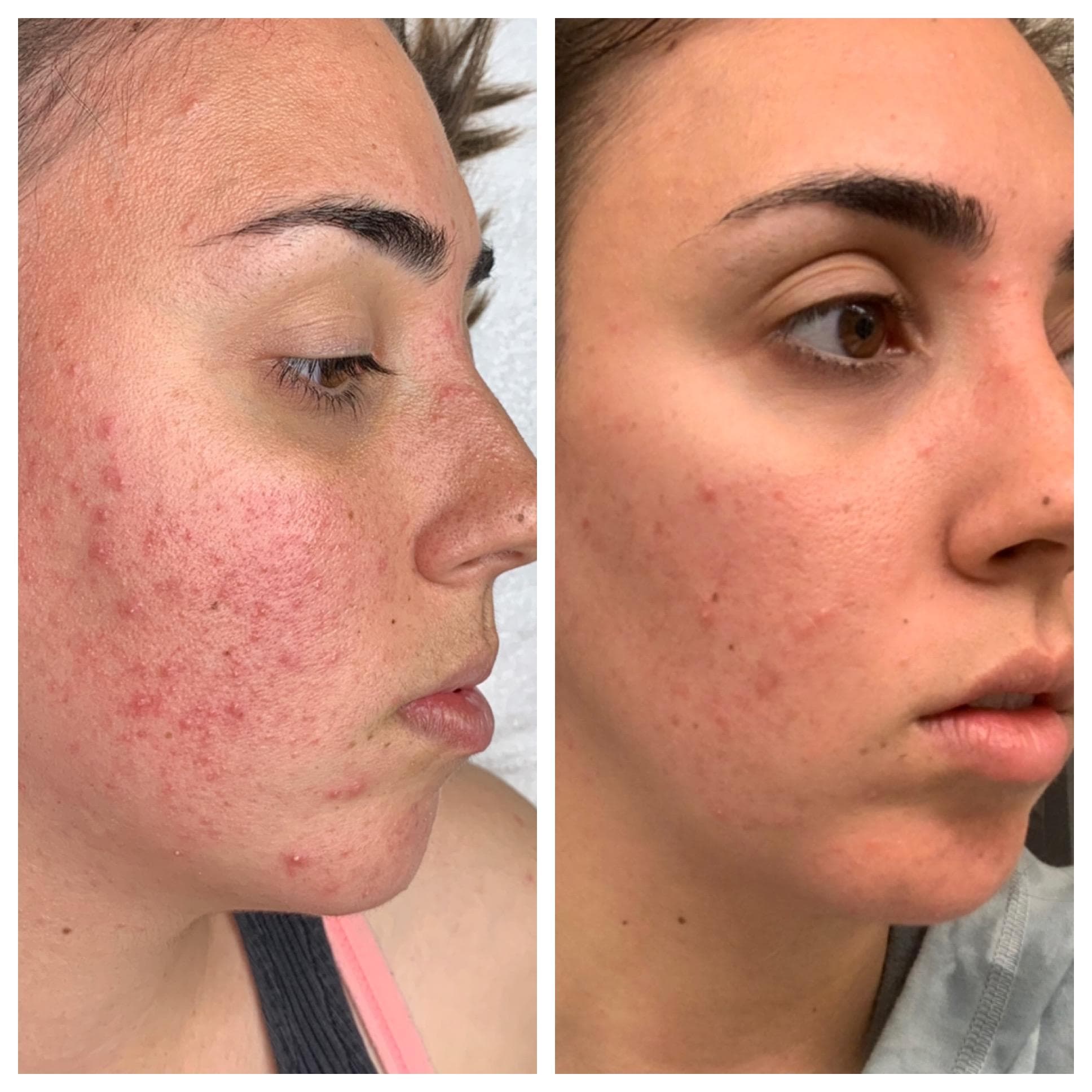 Before and after enzyme therapy skin progress result 08