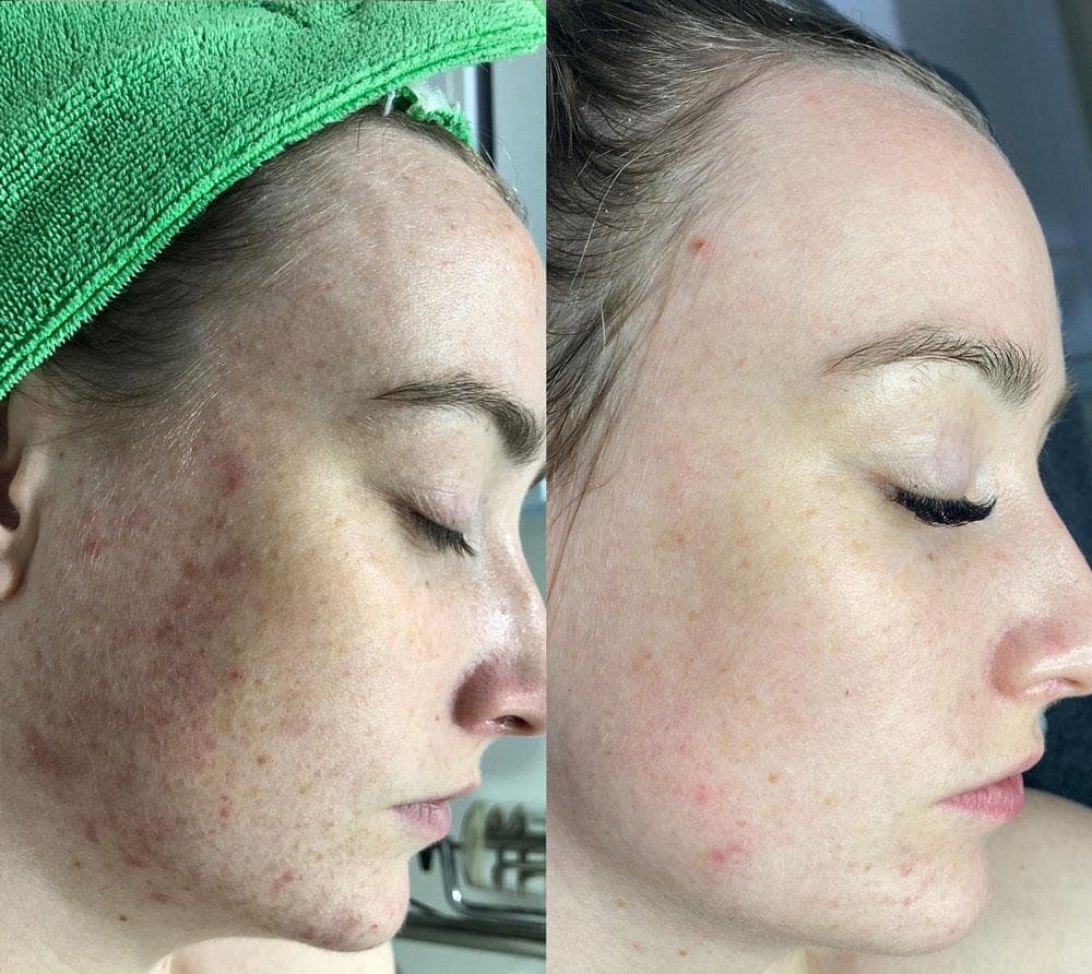 Before and after enzyme therapy skin progress result 09
