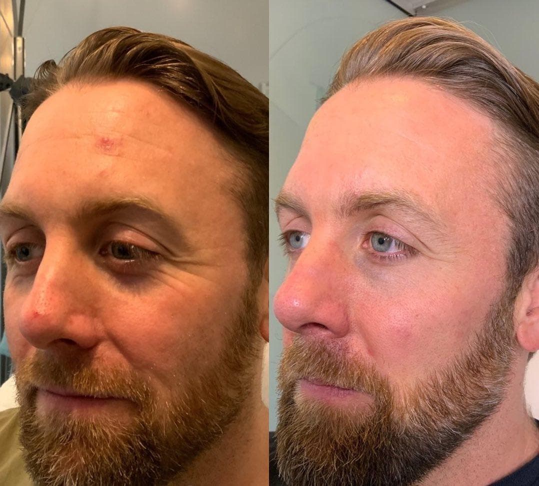 Before and after enzyme therapy skin progress result 10