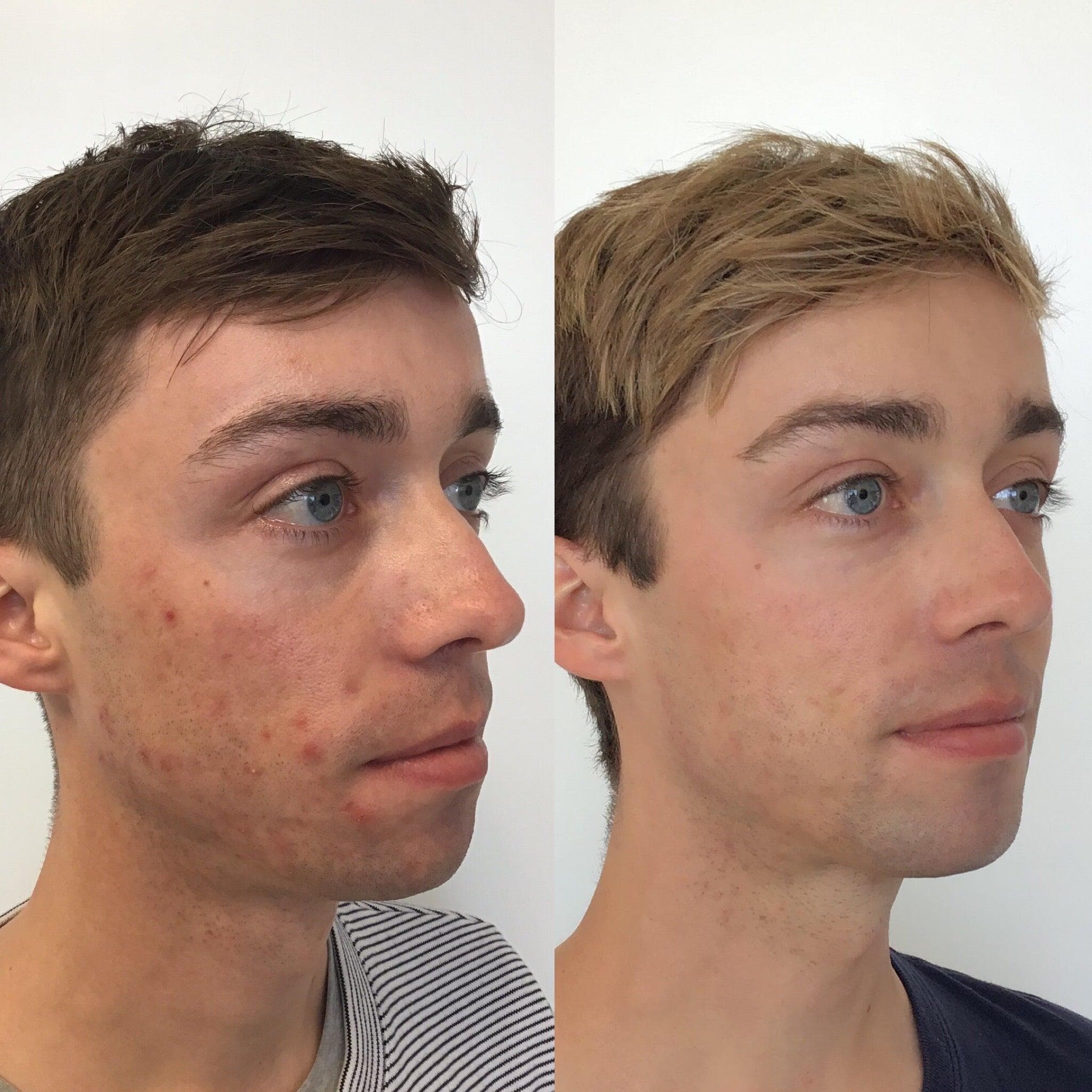 Before and after enzyme therapy skin progress result 11